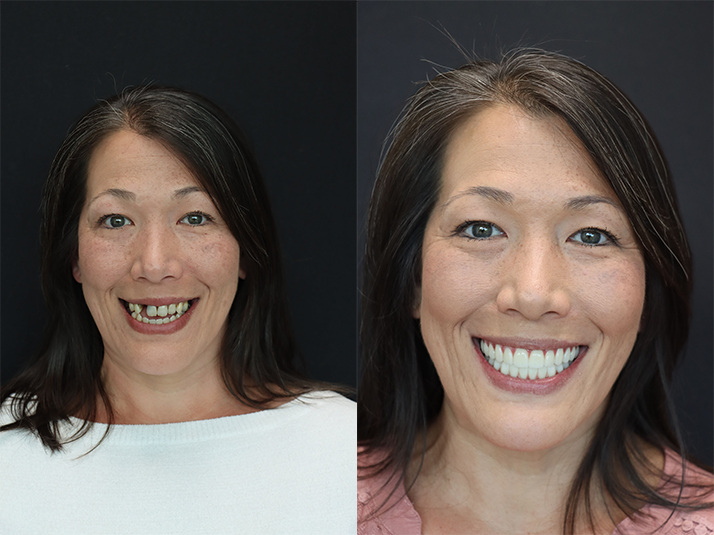 patient's before and after smile