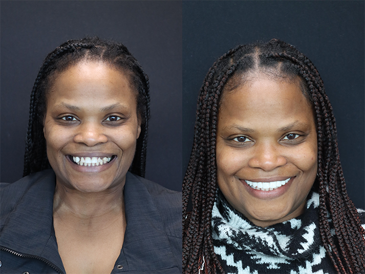 patient's before and after smile